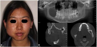 Mandibular Reconstruction With the Contralateral Vascularized Iliac Flap Using Individual Design: Iliac Crest Used to Reconstruct the Ramus and the Anterior Border of the Iliac Wing Used to Reconstruct the Inferior Border: A Case Report